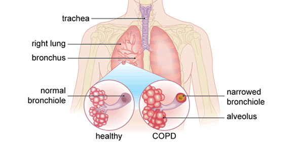 COPD Quizzes, Copd Trivia, Copd Questions