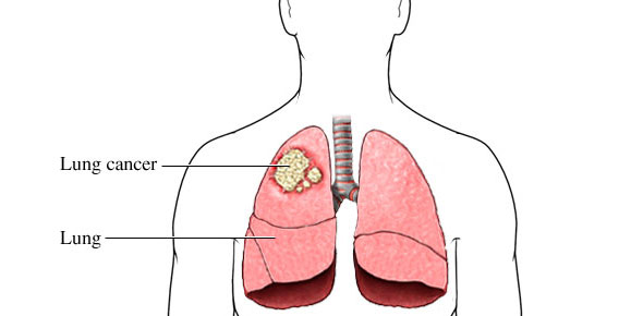 Lung Cancer Quizzes, Lung cancer Trivia, Lung cancer Questions