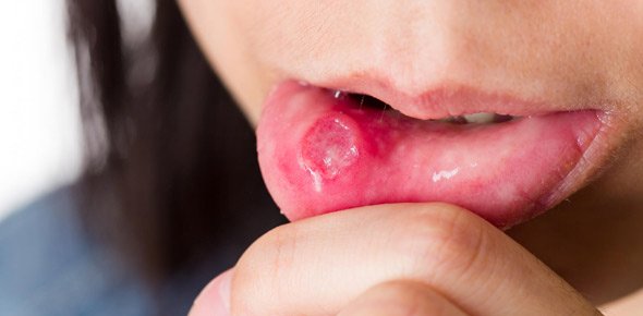 Ulcer Quizzes, Ulcer Trivia, Ulcer Questions