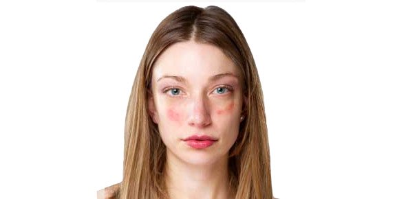 SLE Quizzes, Sle Trivia, Sle Questions