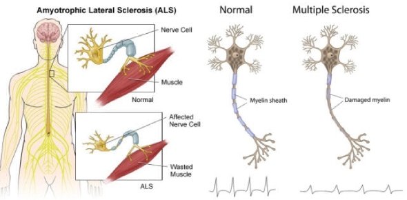 Amyotrophic Lateral Sclerosis Quizzes, Amyotrophic lateral sclerosis Trivia, Amyotrophic lateral sclerosis Questions