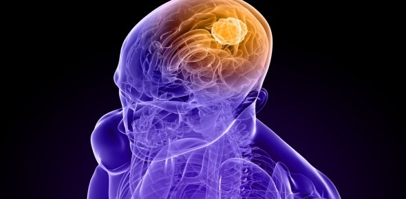 Brain tumor Quizzes, Brain tumor Trivia, Brain tumor Questions